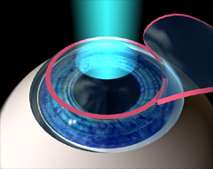 Augenlaser bedeutet meist LASIK (LAser inSItu Keratomileusis), d.h. der Laser Abtrag in der Hornhaut.